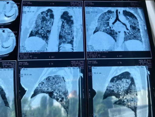 Воронежский врач показала фото поражённых на 96% легких