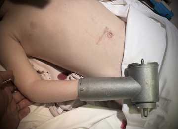 Воронежские врачи достали руку ребенка из мясорубки